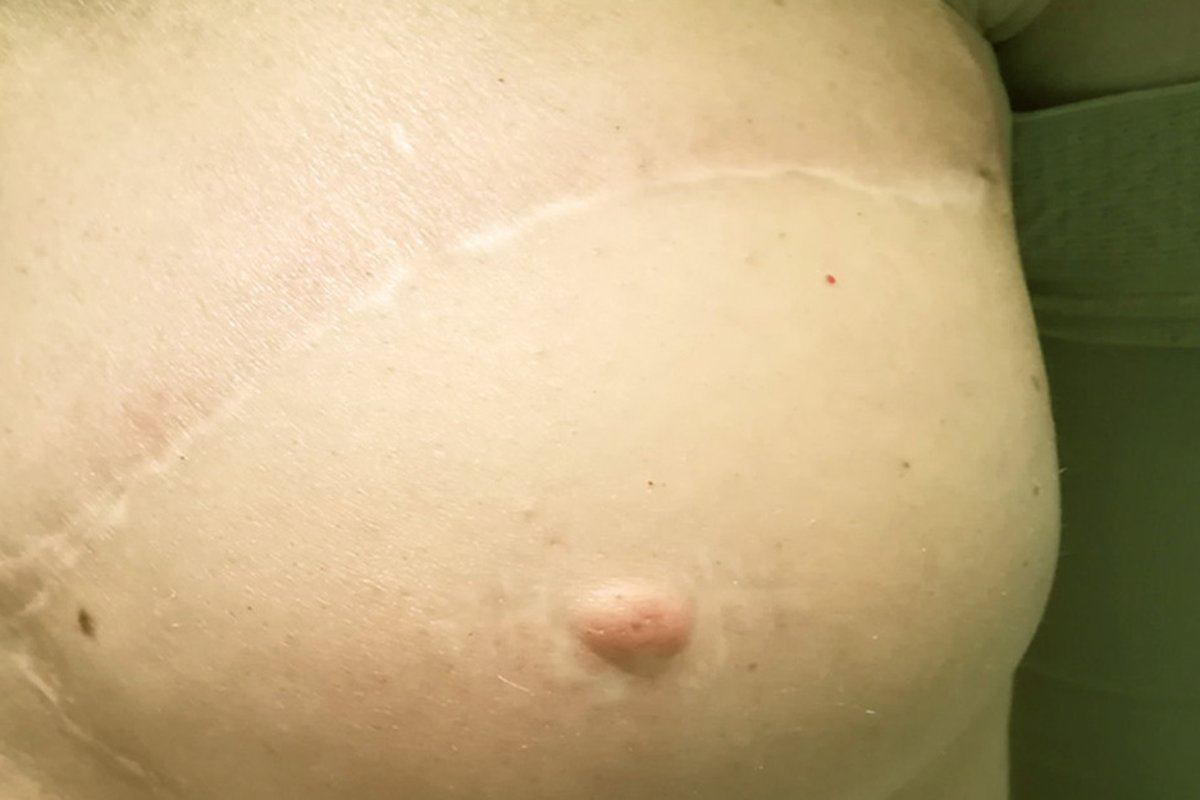 Zona areolare priva di pigmento prima della ricostruzione