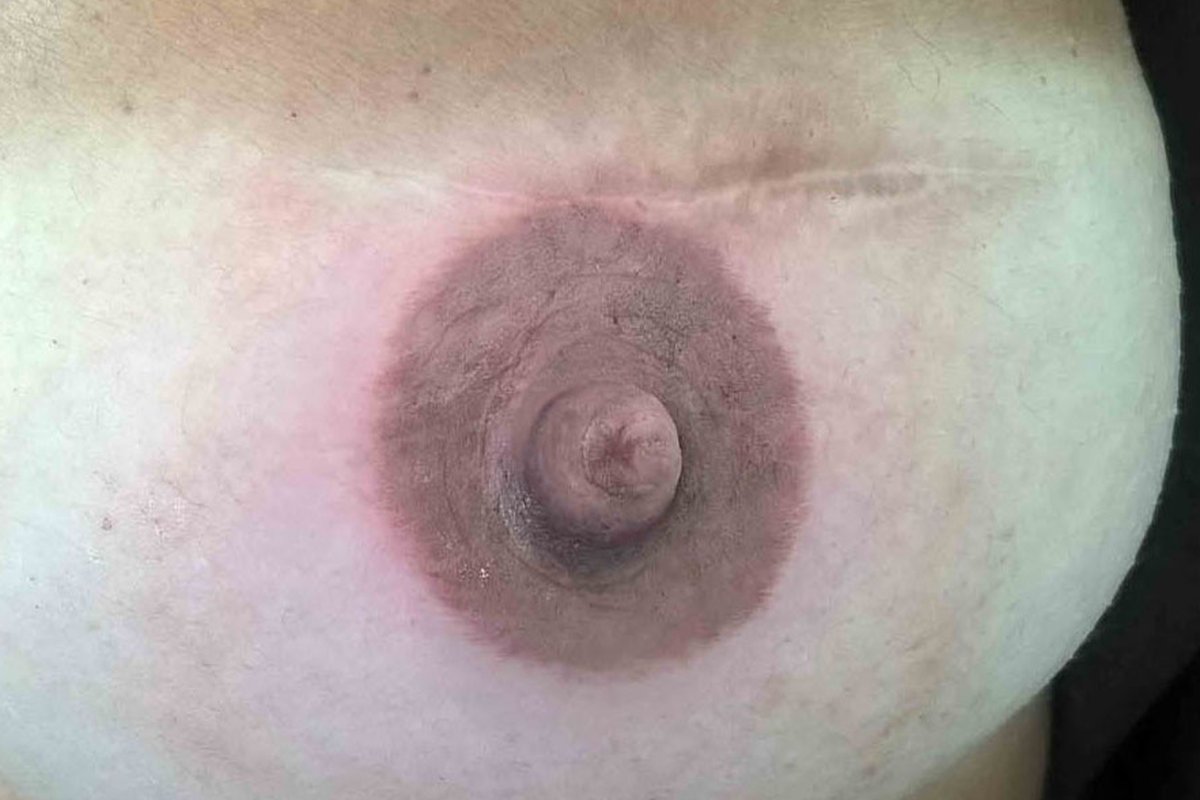 Ricostruzione dell'areola mammaria a Bologna dopo mastectomia