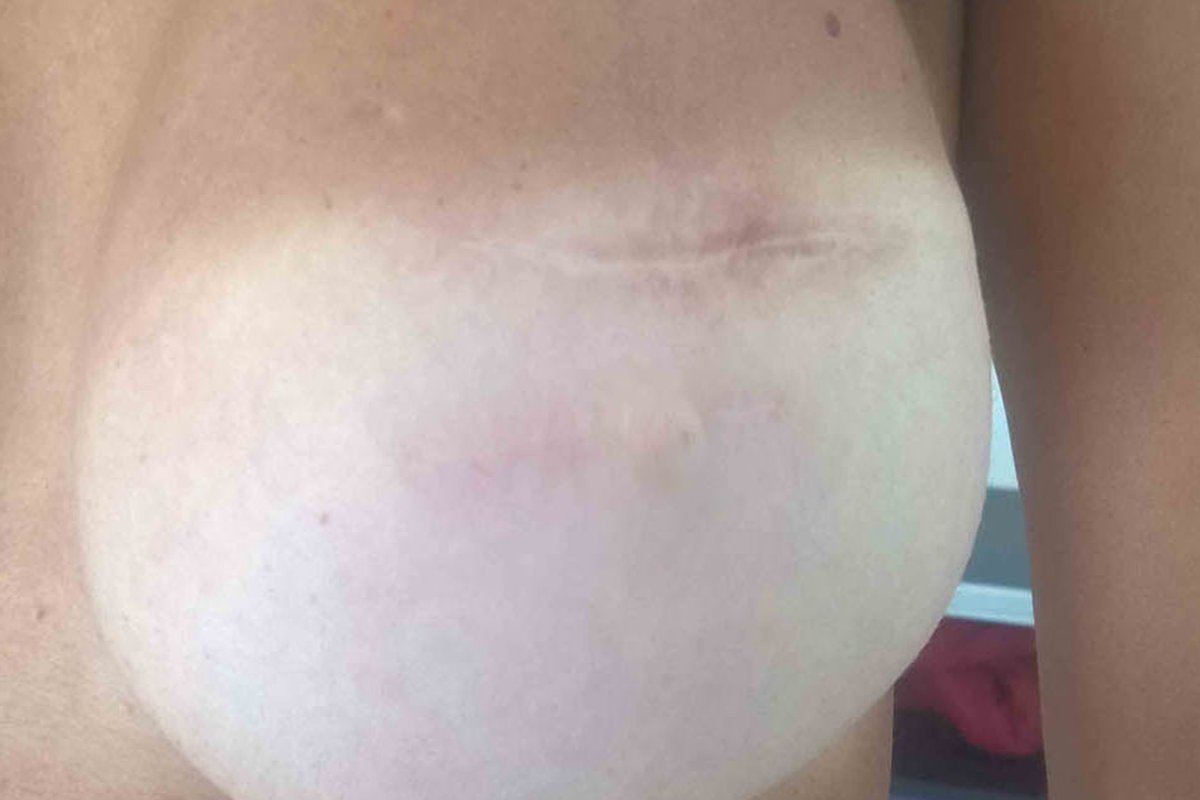 Seno ricostruito con la sola cicatrice, prima della dermopigmentazione dell'areola