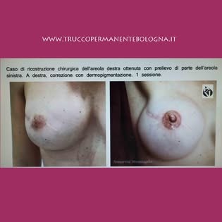 Correzione con dermopigmentazione di un'areola ricostruita chirurgicamente con innesto
