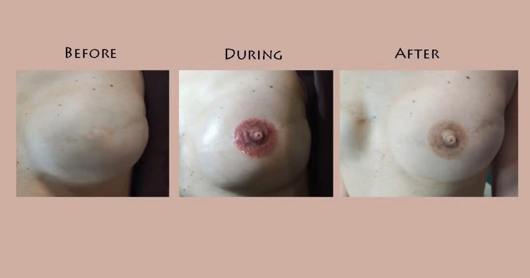 Ricostruzione dell'areola mammaria: il seno prima della dermopigmentazione, il lavoro appena eseguito e il risultato a guarigione completata