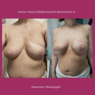Dermopigmentazione di entrambe le areole dopo la ricostruzione del seno
