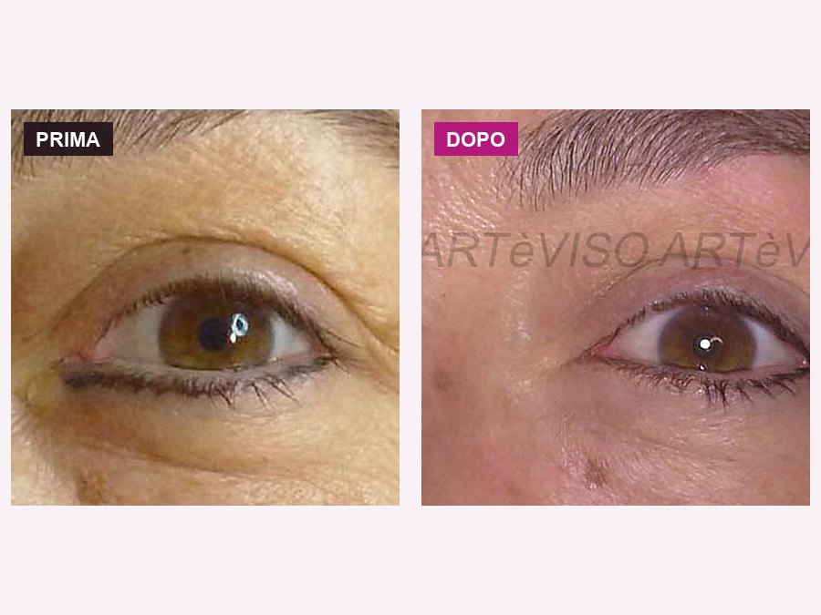 Eyeliner inferiore migrato nel nero, fatto da altri, e il camouflage che lo maschera: correzione del trucco permanente a Bologna