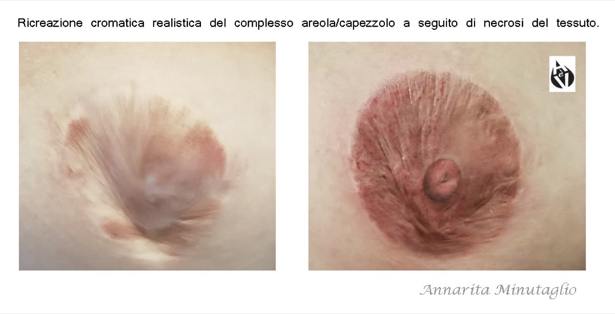 Ricreazione cromatica del complesso areola-capezzolo dopo una necrosi del tessuto