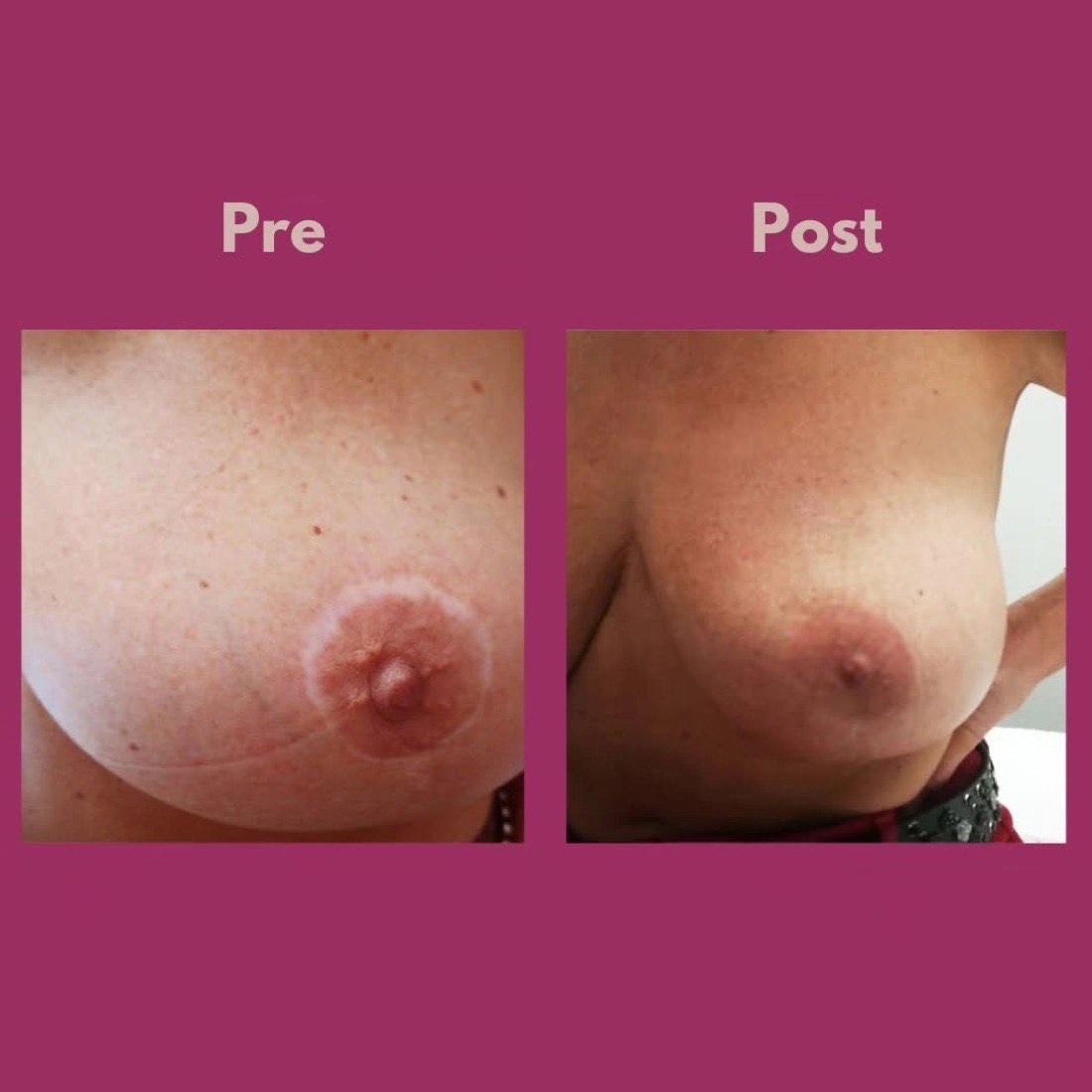 Confronto pre e post della ripigmentazione delle cicatrici attorno all'areola