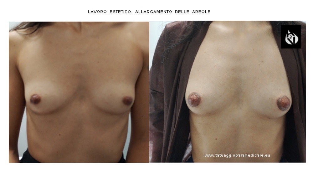 Allargamento estetico del diametro delle areole con la dermopigmentazione