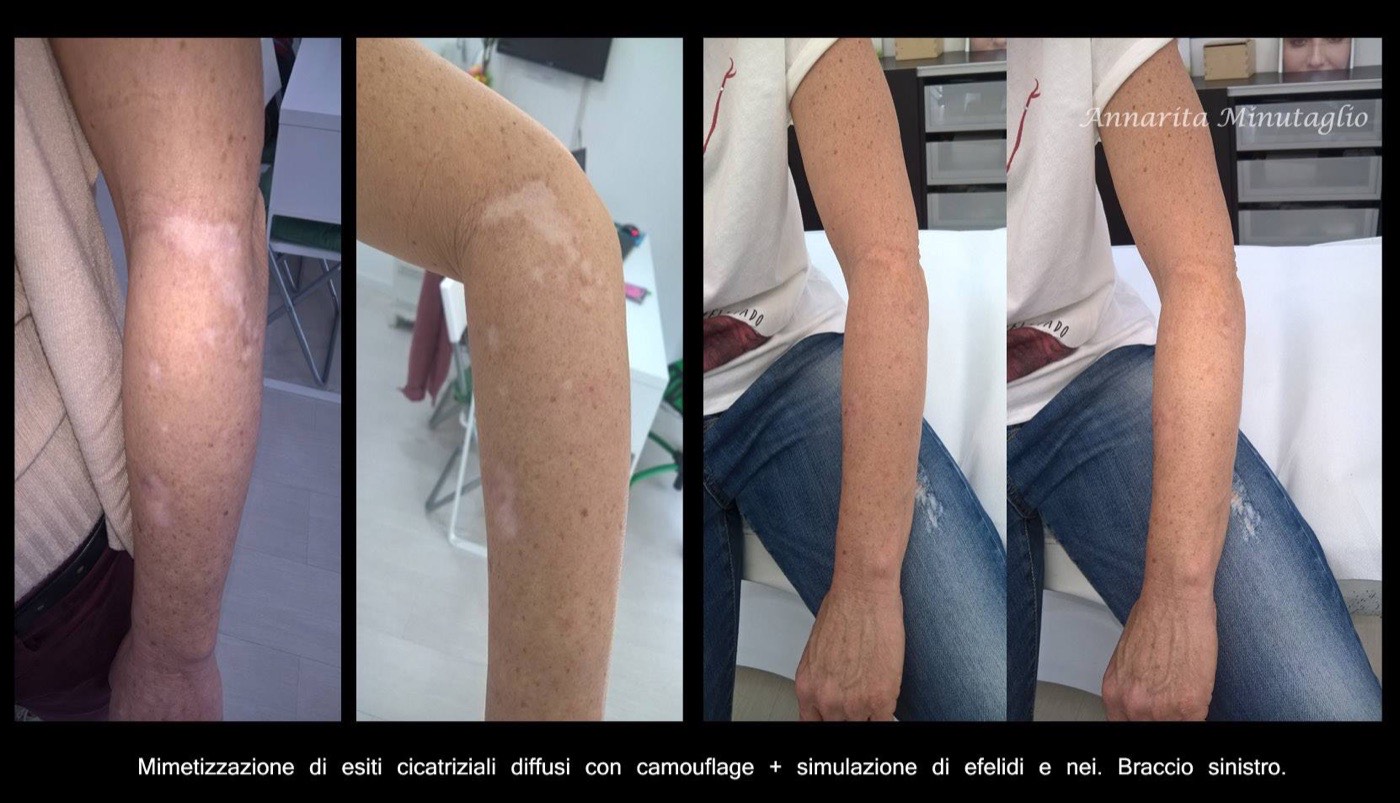 Camouflage di esiti cicatriziali diffusi sul braccio con simulazione di efelidi e nei