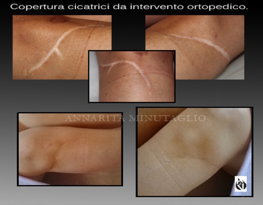 Copertura con dermopigmentazione delle cicatrici bianche lasciate da un intervento ortopedico al braccio