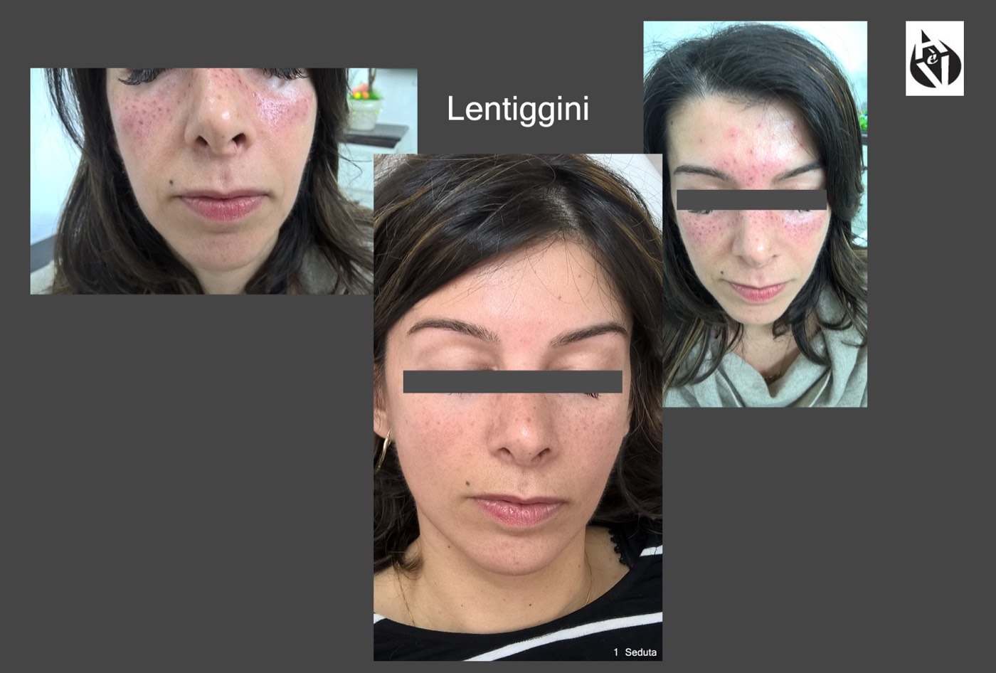 Lentiggini simulate con la dermopigmentazione su richiesta della cliente, prima e dopo