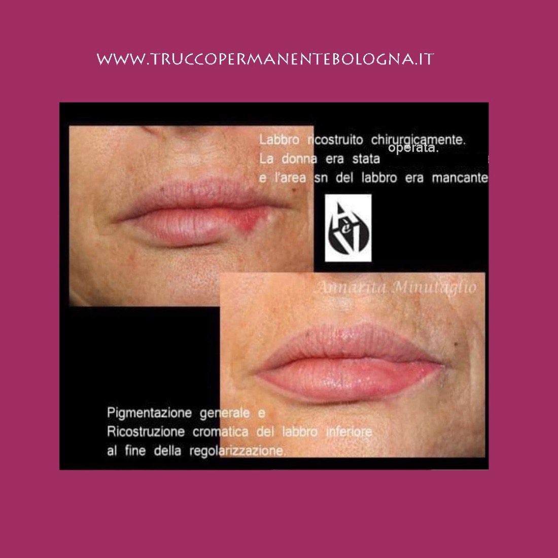 Ricostruzione cromatica del labbro inferiore ricostruito chirurgicamente dopo un intervento