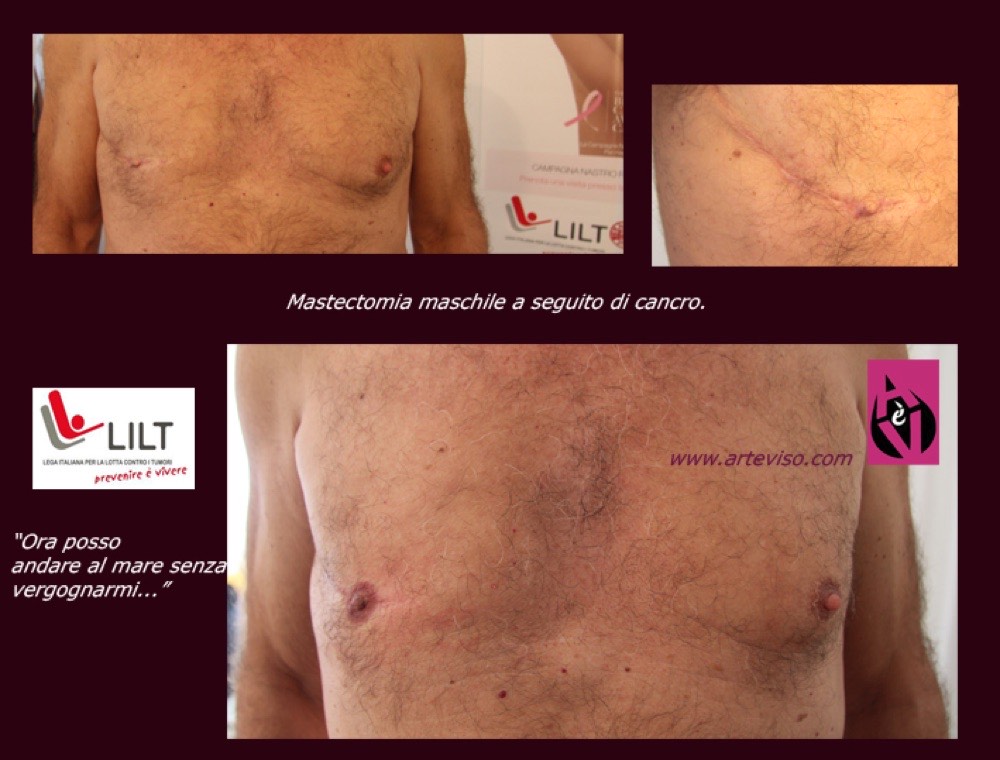 Ricostruzione del capezzolo dopo una mastectomia maschile per tumore al seno