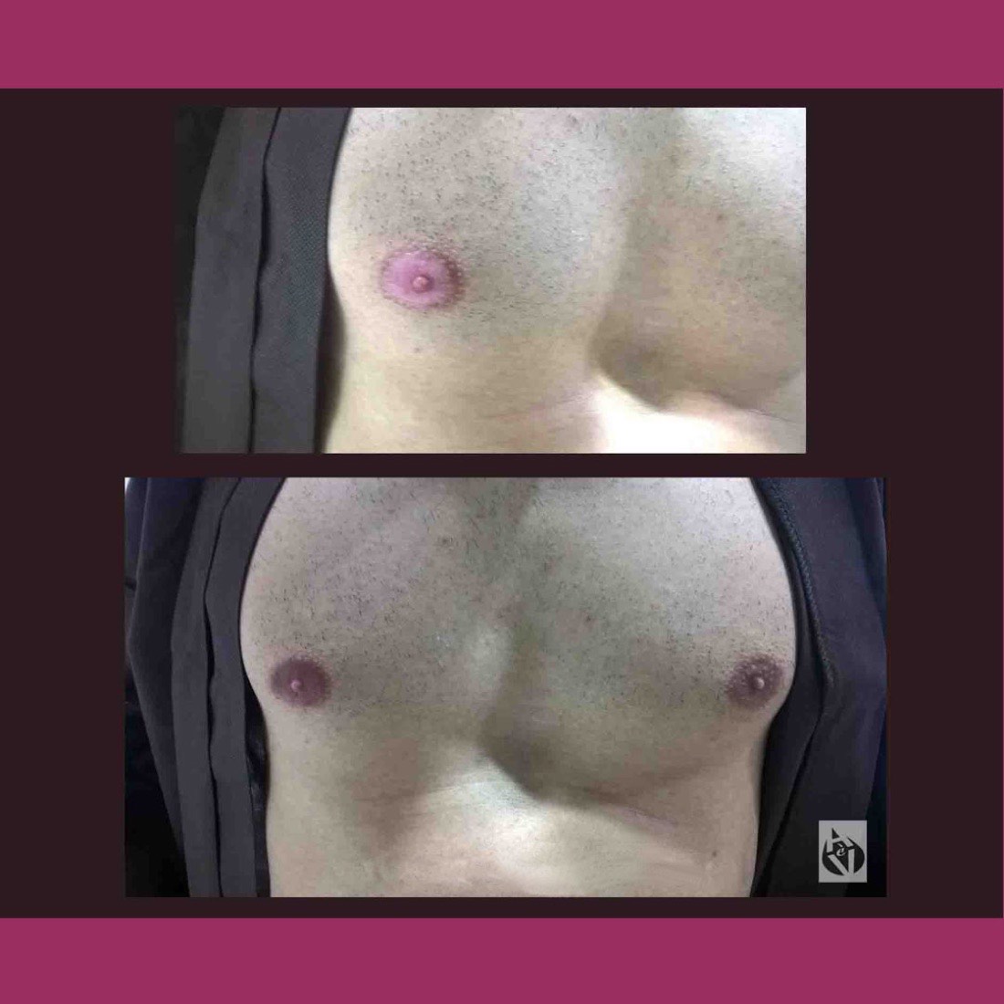 Ripigmentazione di un'areola depigmentata dalla vitiligine sul torace di un uomo
