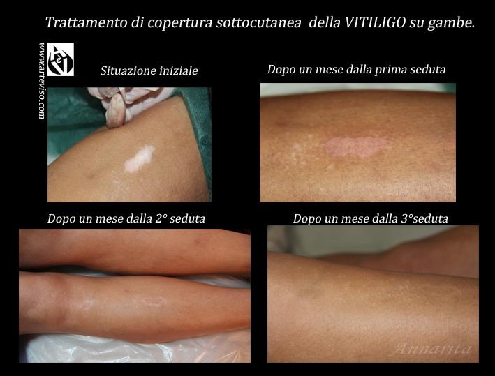 05 tatuaggio paramedicale vitiligo